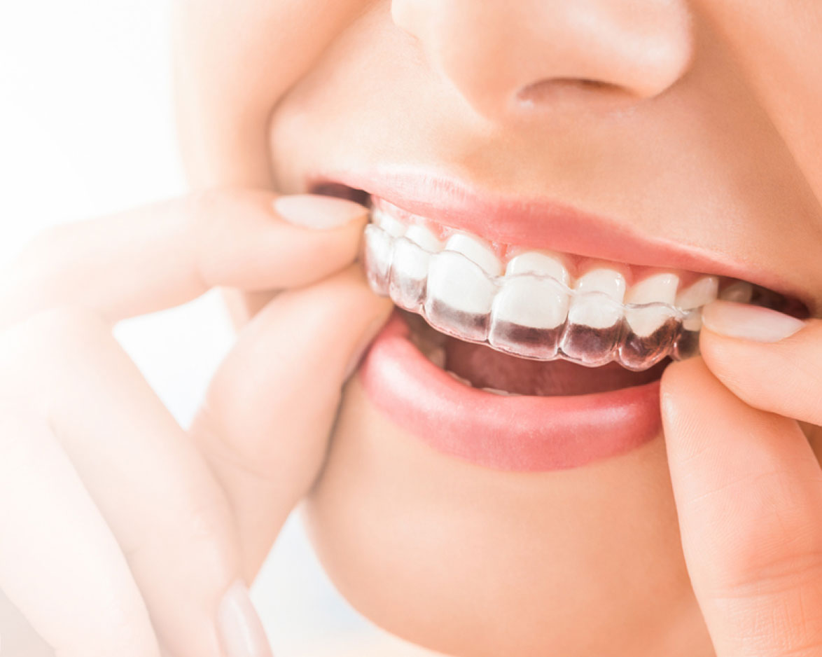 Invisalign
