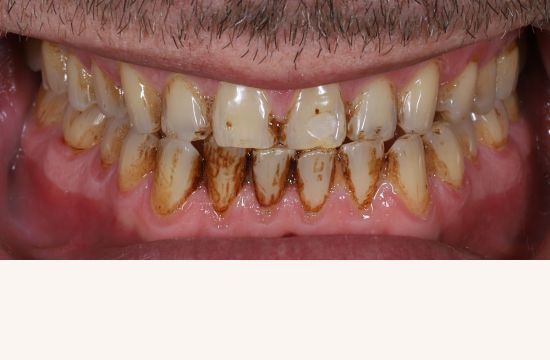 Before