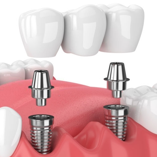 Dental Implants