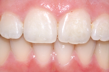 Icon white spot before treatment