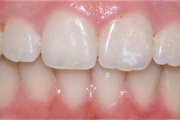 Icon white spot after treatment
