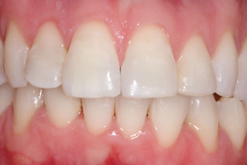 Icon white spot before treatment
