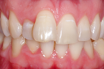 Icon white spot after treatment