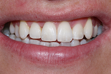 Icon white spot before treatment
