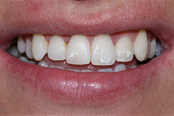 Icon white spot after treatment